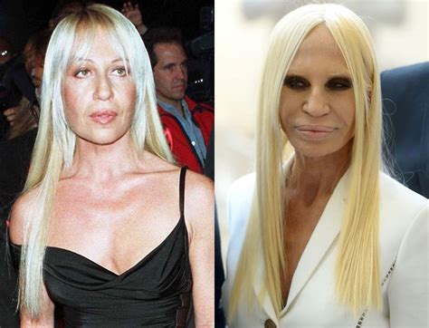 donatella versace rai|donatella versace before and after surgery.